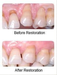 Periodontal treatment, before and after