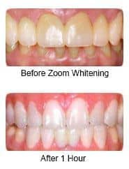Laser whitening of teeth procedure