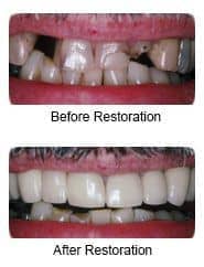 Prosthodontics with crowns and bridgework, before and after restoration