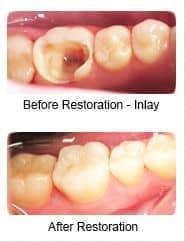 Tooth-colored inlay, before and after restoration