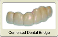 Cemented dental bridgework, specimen