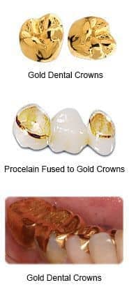Gold dental crowns - Porcelain fused to gold dental crowns - Gold dental crown work applied