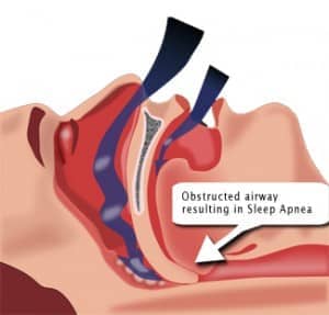 Obstructed Airway - OSA