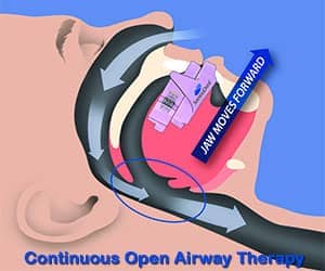 SomnoDent - Continuous Open Airway Therapy