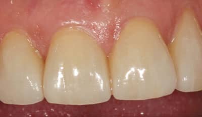 After microfracture restoration with dental veneers