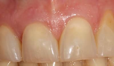 Before microfracture restoration with dental veneers