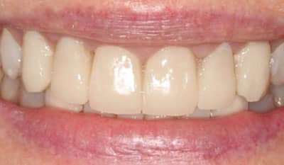 After microfracture restoration with dental veneers