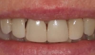Before microfracture restoration with dental veneers