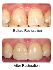 Dental bonding, before & after restoration