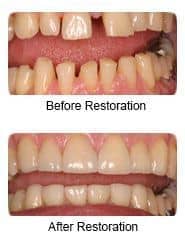 Dental crowns and veneers, before & after restoration