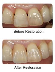 All-ceramic crowns, before & after restoration