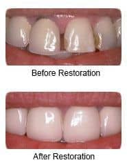 Pocrelain veneers, before and after restoration