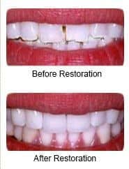Porcelian veneers, before and after restoration