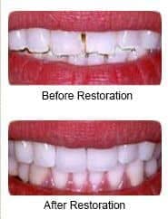 Porcelian veneers, before and after restoration