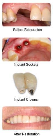 Dental implant, before and after views