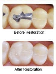 Tooth-colored filling, before and after restoration