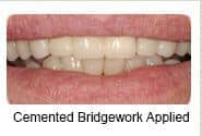 Cemented bridgeword applied to patient