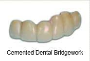 Cemented dental bridgework, specimen