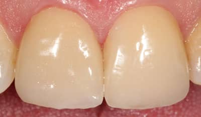 After dental crown trauma restoration