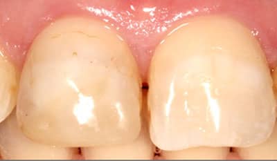 Before dental crown trauma restoration