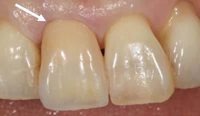 After dental crown trauma restoration