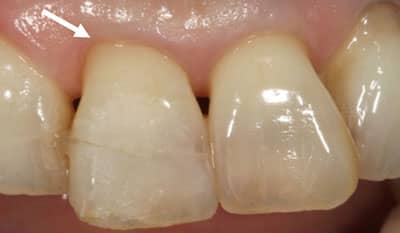 Before dental crown trauma restoration
