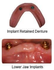 implant retained dentures