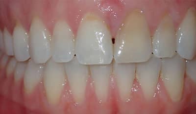 Invisalign correction - crowding - After