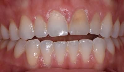 Invisalign correction - crowding - Before