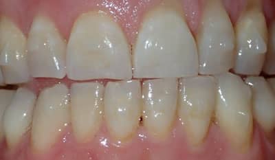 Invisalign correction - crowding - After