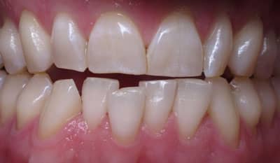 Invisalign correction - crowding - Before