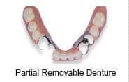 Partial denture