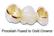 Procelian fused to gold