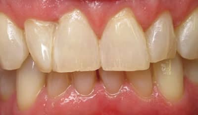 After whitening treatment