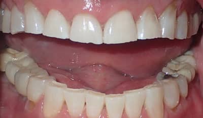 After whitening treatment