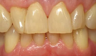 Before whitening treatment