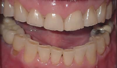 Before whitening treatment