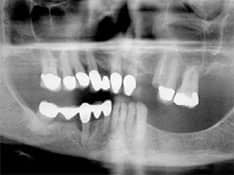 Dental X-ray