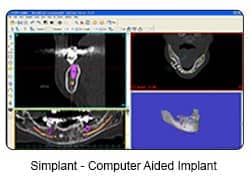 Simplant Computer Aided Implants